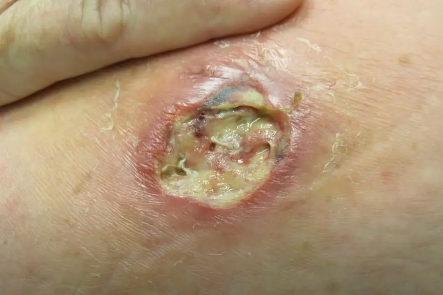 cockroach bite