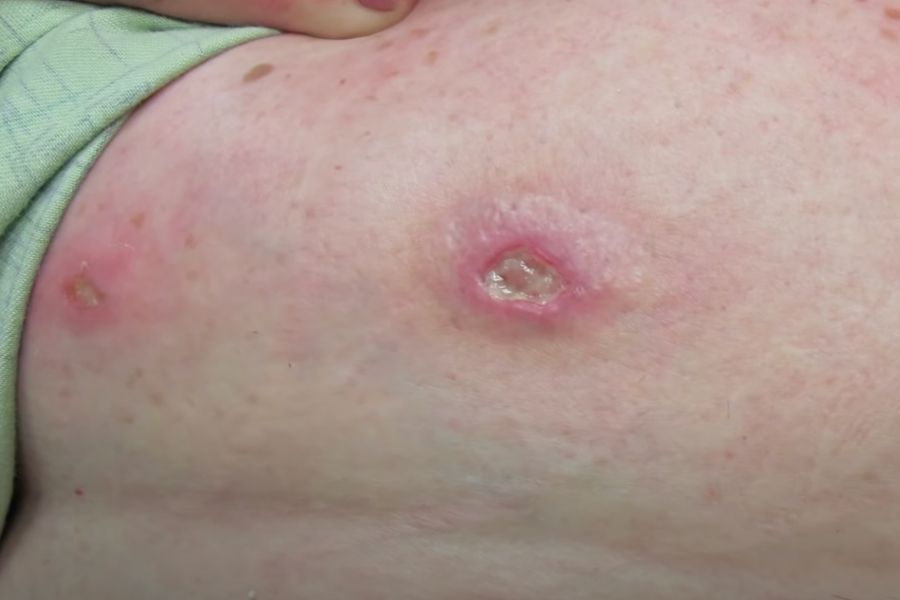 45-Year-old female patient with inflamed cockroach bite on her abdomen, Source (Larry Mellick, MD).