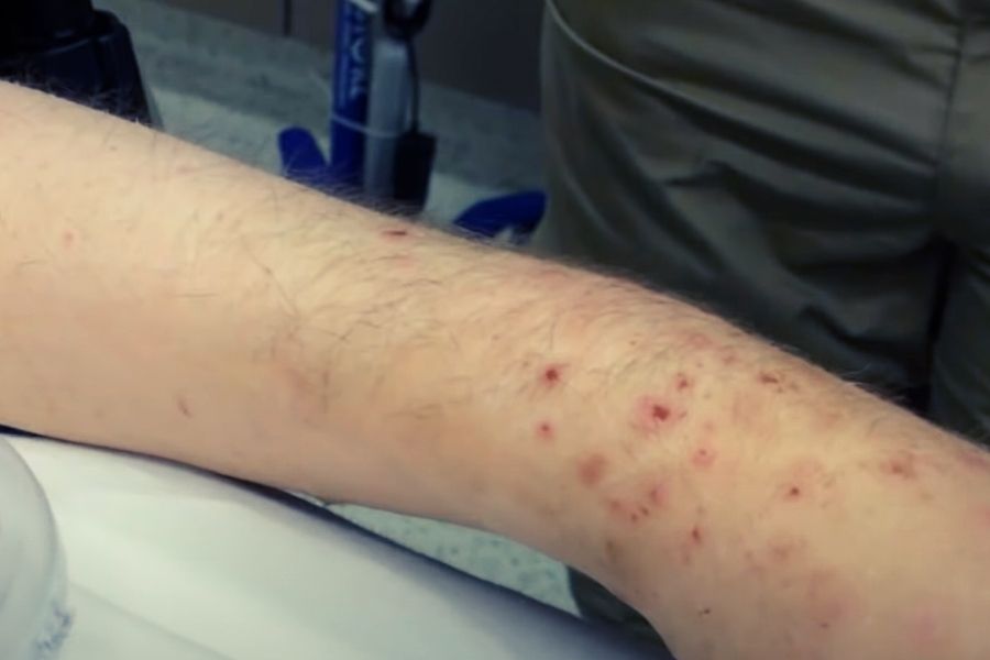 A handicapped male patient with multiple cockroach bites on his arm. Source (Larry Mellick, MD).